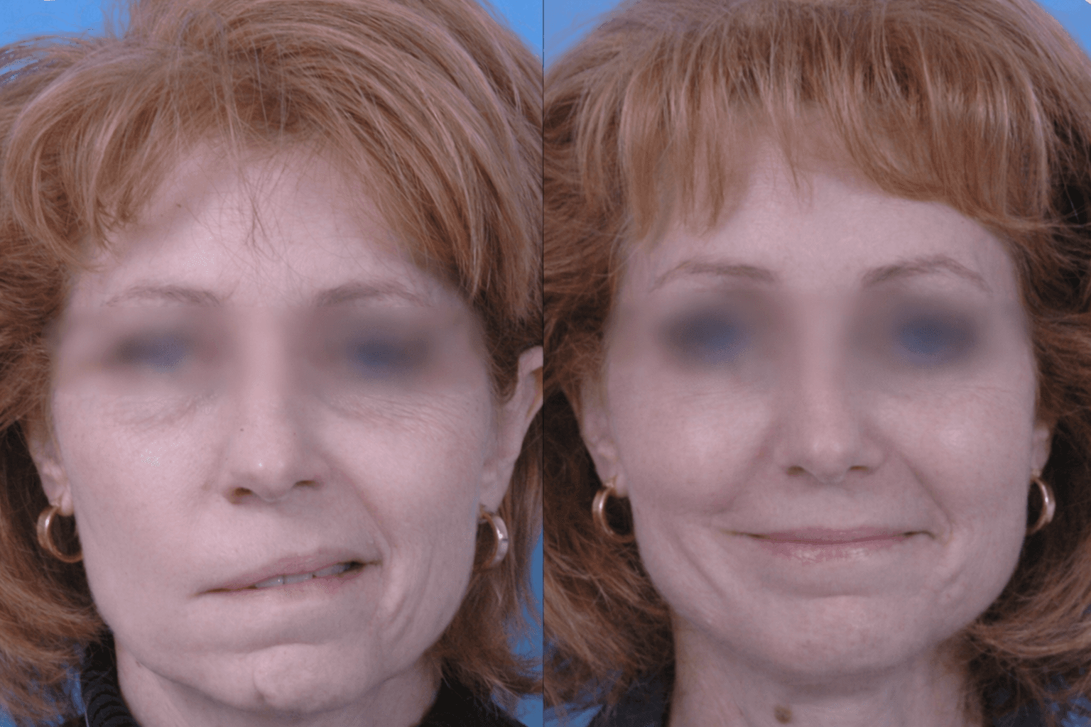 Paralysie faciale : comment la kinésithérapie aide à récupérer son sourire