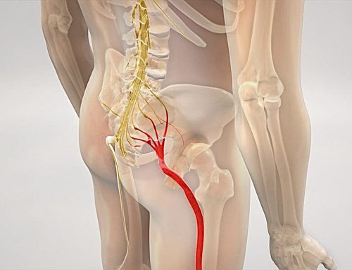 Comment soulager une sciatique rapidement ? Traitement et conseils efficaces